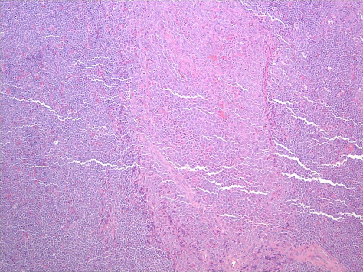 Image 1 Lymph node biopsy